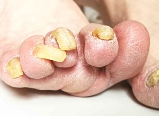 gingerbread nails disease